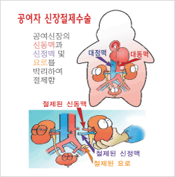 복강경 수술 또는 개복 수술