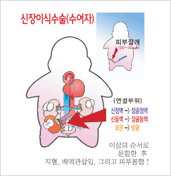 개복 수술