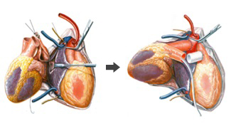 심장이식 수술 이미지2