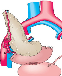 췌장이식술-방광 문합술
